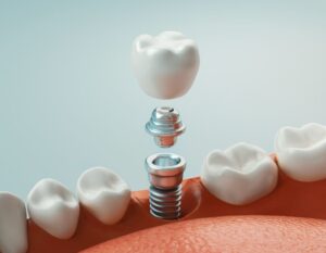 same day dental implants scottsdale az 
